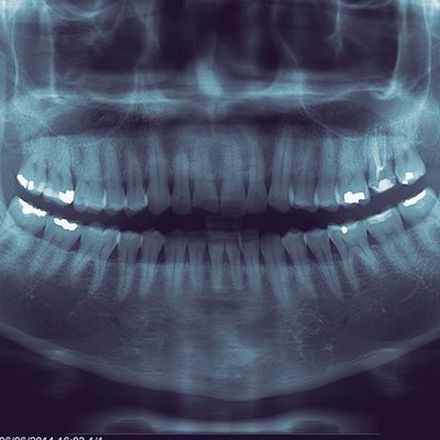 iopa-rvg-and-full-mouth-x-ray-opg